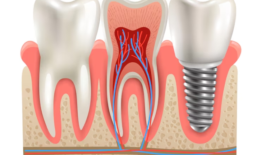 Demystifying Dental Implants: A Comprehensive Guide to Costs and Considerations