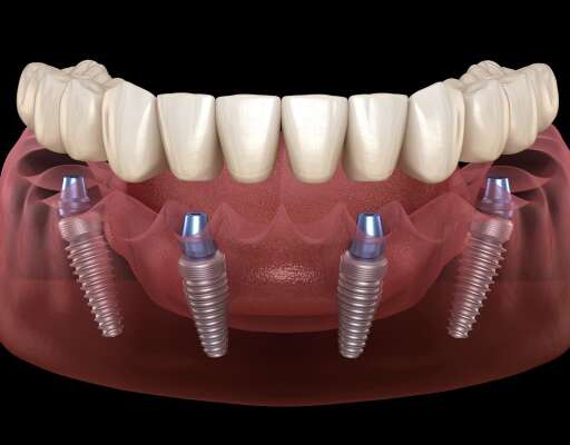 Are Full-Mouth Dental Implants Right for You?