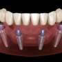 full-mouth dental implants