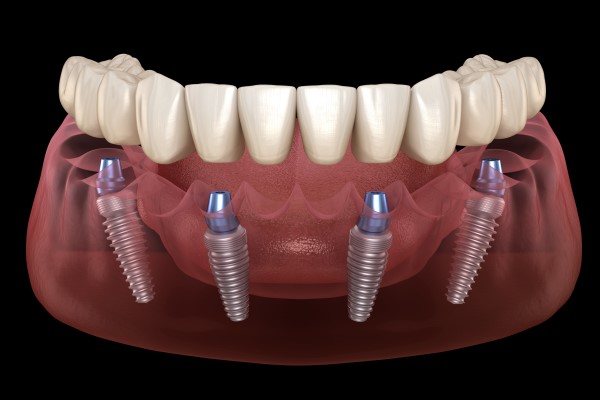 Are Full-Mouth Dental Implants Right for You?